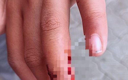 ಗೋಣಿಕೊಪ್ಪ:ಬೀದಿ ನಾಯಿ ದಾಳಿಗೆ ವಿದ್ಯಾರ್ಥಿಗಳು ಸೇರಿ ನಾಲ್ವರಿಗೆ ಗಾಯ:  ಬೀದಿ ಶ್ವಾನವನ್ನು ಹೊಡೆದ ಸಾಯಿಸಿದ ಸ್ಥಳೀಯರು