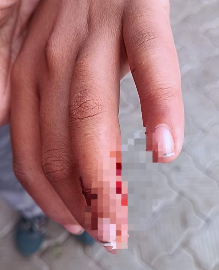 ಗೋಣಿಕೊಪ್ಪ:ಬೀದಿ ನಾಯಿ ದಾಳಿಗೆ ವಿದ್ಯಾರ್ಥಿಗಳು ಸೇರಿ ನಾಲ್ವರಿಗೆ ಗಾಯ:  ಬೀದಿ ಶ್ವಾನವನ್ನು ಹೊಡೆದ ಸಾಯಿಸಿದ ಸ್ಥಳೀಯರು