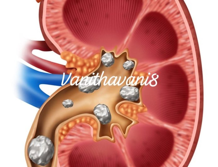 ಮೂತ್ರಕೋಶದಲ್ಲಿ ಕಲ್ಲಿನ ಸಮಸ್ಯೆಯೇ!